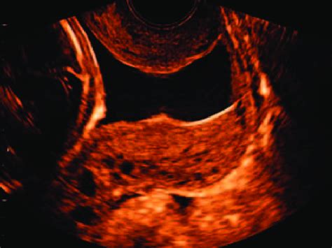 Dilated Cervix Ultrasound