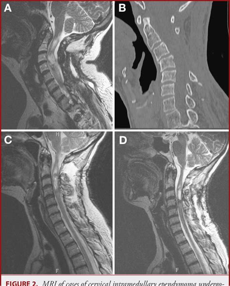 Shortterm Progressive Spinal Deformity Following Laminoplasty Versus