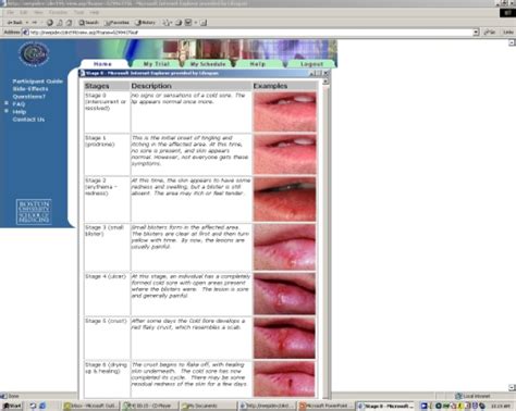 Standard Pictorial Illustration Of Cold Sore Stages As Open I