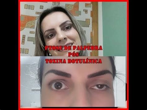 Fisioterapia Para Olho Maior Que O Outro Sobre Os Olhos