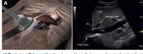 Figure 1 From Inferior Vena Cava Collapsibility Index Clinical