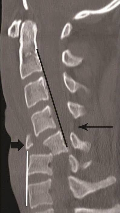 Flexion Teardrop Fracture Cervical