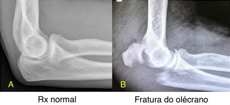 Fratura do olécrano Dr Artur Utino Membro do grupo de ombro e