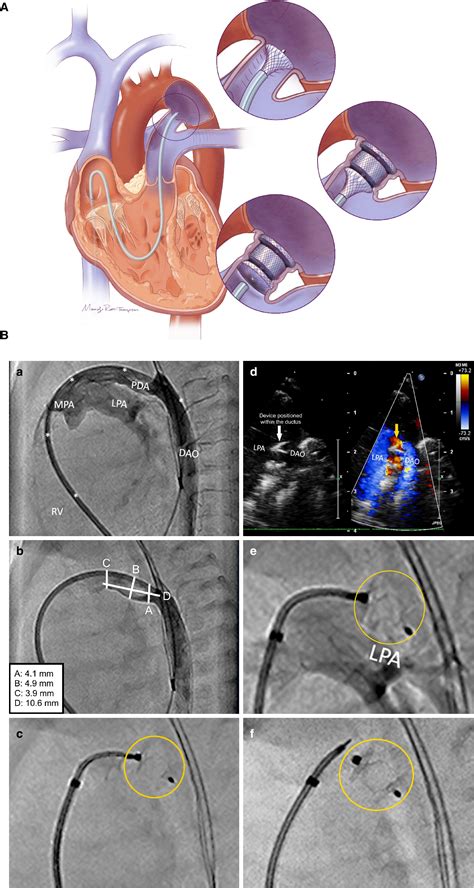 Patent Ductus Arteriosus Gross