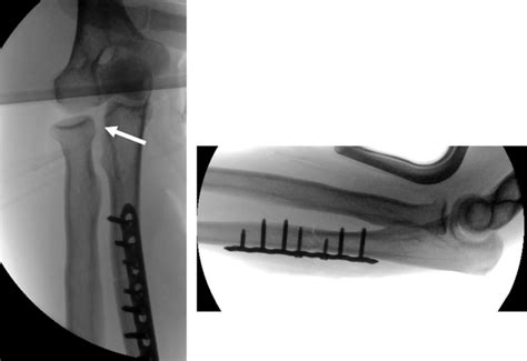 Intraoperative X Ray After Plate Osteosynthesis Of A Monteggia Fracture