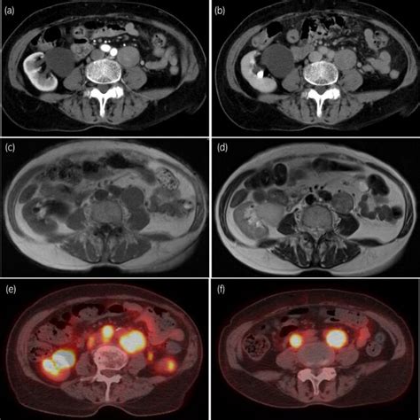 Imaging Tests At The First Diagnosis A B Abdominal Computed