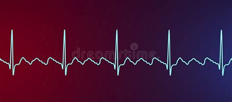 Ecg In Atrial Flutter An Abnormal Heart Rhythm Characterized By Rapid