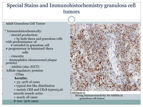 Sex Cord Stromal Tumors Pathology Ppt