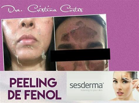 Revolucionario Peeling De Fenol Para Tratar Arrugas Superficiales