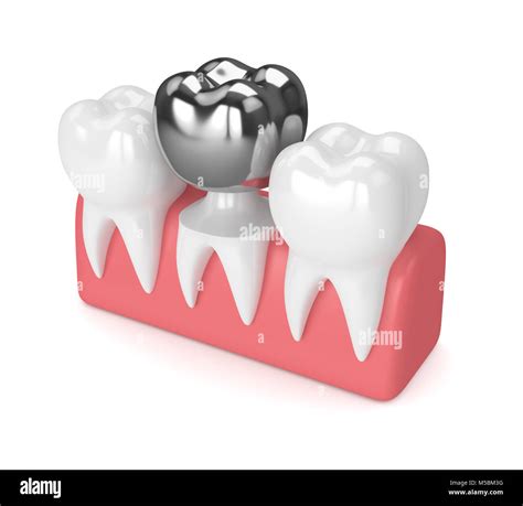 D Render Of Teeth With Dental Crown Amalgam Filling In Gums Over White