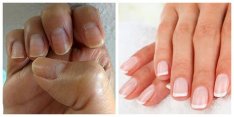 Unghie Striate Verticalmente Cause Nail Accessories