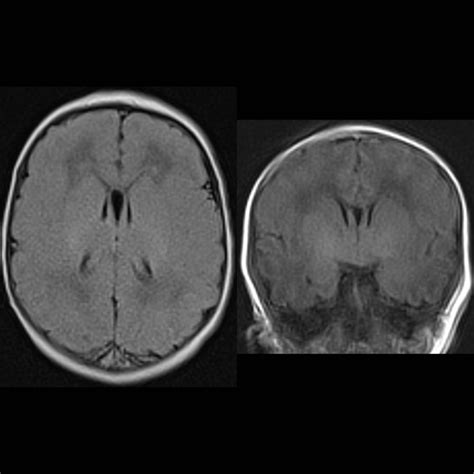 Newborn with myelomeningocele | Pediatric Radiology Case | Pediatric ...