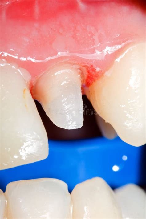 Tooth Stub For Crown Stock Photo Image Of Discolored 13823948