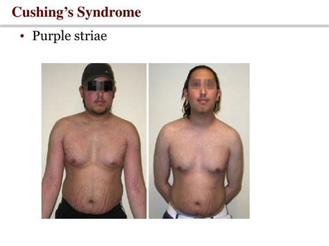 Cushing Syndrome Exogenous As Related To Diabetes Pictures