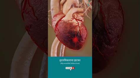 हृदयविकाराच्या झटक्यादरम्यान काय होते ↪ 3d Medical Animation Shorts