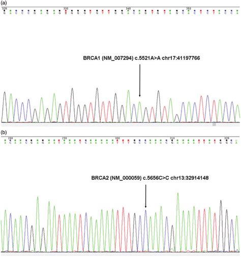 Sanger Sequencing Analysis Of The MRNA Expression Of BRCA1 S1841