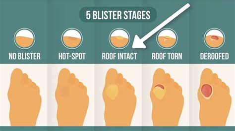 How To Heal Cut Blisters Heal Info