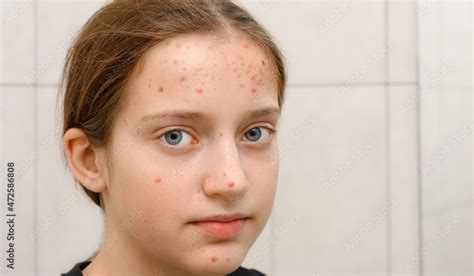 Face Of A Teenage Girl With Pimples Acne On The Skin Portrait Of Puberty Girl Photos Adobe Stock