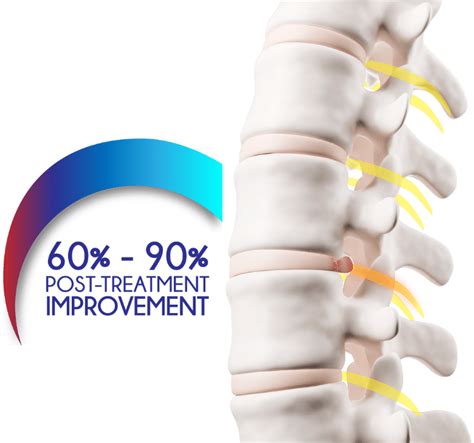 Facet Joint Osteoarthritis Causes Symptoms And Treatments