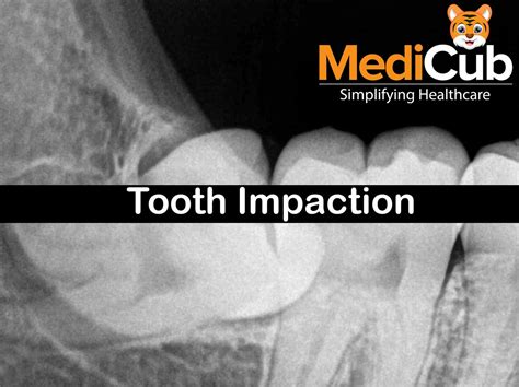 Tooth Impaction Impacted Teeth Are The Teeth That Stay By Medicubhealthcare Medium