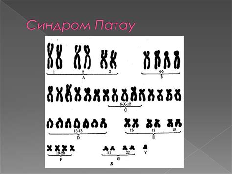 Синдром Патау - презентация онлайн