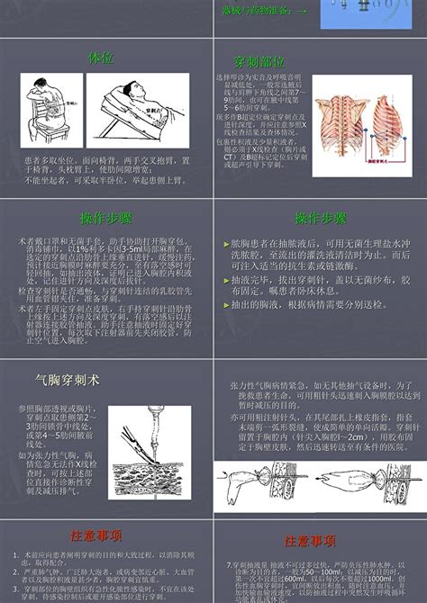 胸腔穿刺术及胸腔闭式引流术 ppt模板 卡卡办公