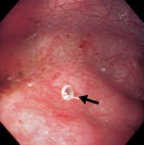 Successful Treatment Of A Gastric Dieulafoy S Lesion With A Hemoclip In A Newborn Infant