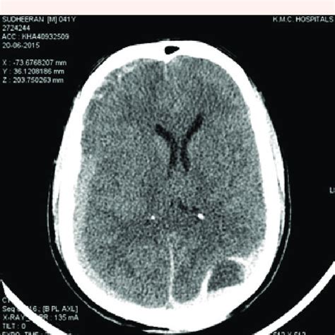 Postoperative Plain Ct Brain Showing A Significant Increase In The Download Scientific Diagram