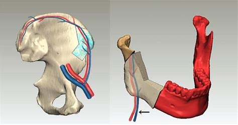 Sketch Map Showing The Relationship Between The Vessel Pedicle And The Download Scientific