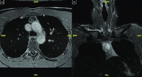 A Multiplanar MR Thorax With T1 Weighted And T2 Weighted Sequences A