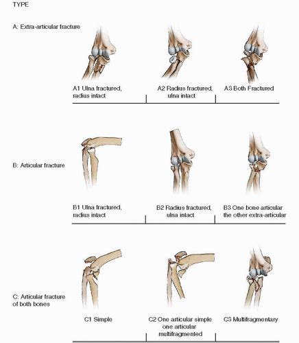 Olecranon Fractures Open Reduction And Internal Fixation