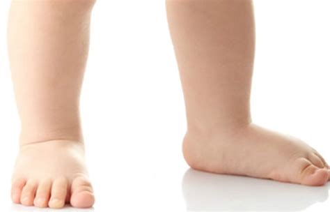 القدم المسطحة الفلات فوت عند الأطفال Flatfoot In Children الدكتور