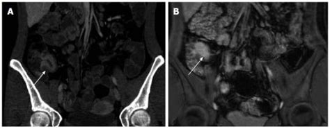 2 Active Crohn S Terminal Ileitis Depicted On Computed Tomography Download Scientific Diagram