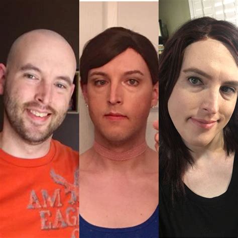 34 Mtf 3 Years Hrt Day 1 Hrt 8 Months Hrt Transtimelines