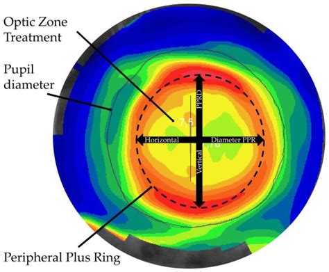 Jcm Free Full Text The Role Of Back Optic Zone Diameter In Myopia Control With