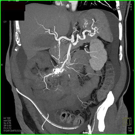 Carcinoid Tumor Near Root Of The Mesentery With Desmoplastic Reaction