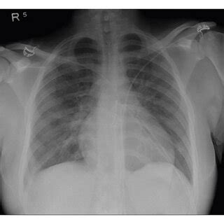 Antero Posterior Ap View Chest X Ray Showing Bilateral Infiltrates