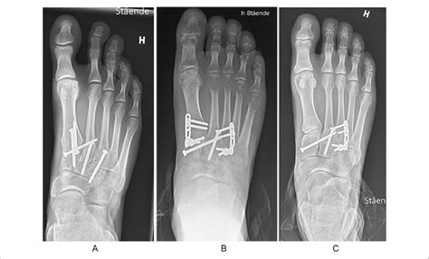 A Primary Arthrodesis Of The 3 Medial Tmt Joints B Temporary