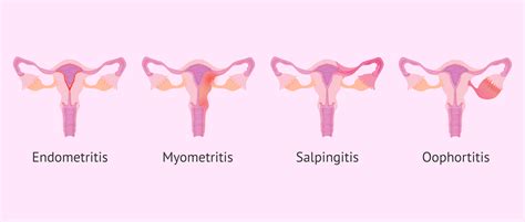 What Is Salpingitis Causes Symptoms And Treatment