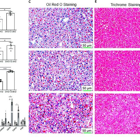 Sms1sms2 Deficiency Mediated Lipogenesis Inflammation Fibrosis And