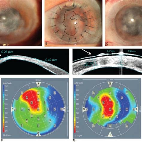 Preoperative And Postoperative Examinations Of A Typical Case