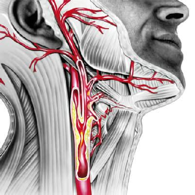 CAROTID ARTERY DISEASE