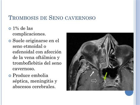 Ppt Rinosinusitis Powerpoint Presentation Id2364560