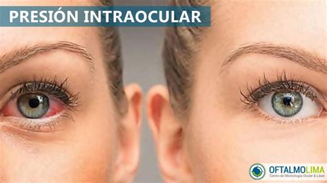 Presión Intraocular Síntomas Causas Y Tratamiento Oftalmolima