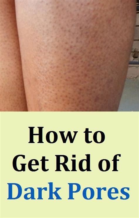 How To Get Rid Of Dark Pores Strawberry Legs In 2020 Dark Pores Leg Hair How To Get Rid