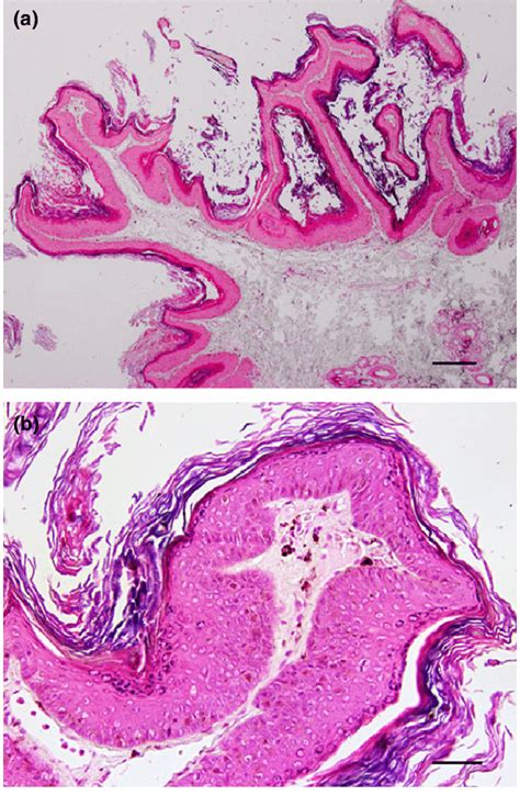 Histology Of The Skin Biopsy From Fully Developed Lesions A The