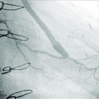 Hemodynamic study of a large saphenous vein graft implanted in a ...