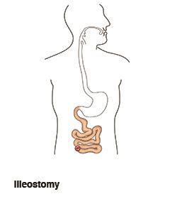 Essential Facts About Your Ileostomy - Ostomy Care Canada