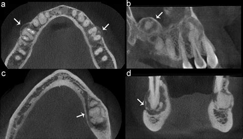 Focal Cemento Osseous Dysplasia