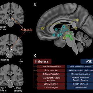 Habenula volume differences found in ASD. (A) Example MAGeTBrain... | Download Scientific Diagram